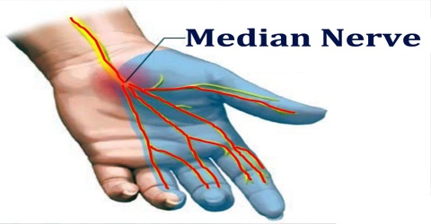 vật lý trị liệu tổn thương thần kinh giữa