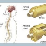 CHẨN ĐOÁN VÀ ĐIỀU TRỊ PHỤC HỒI CHỨC NĂNG HỘI CHỨNG GUILLAIN - BARRÉ